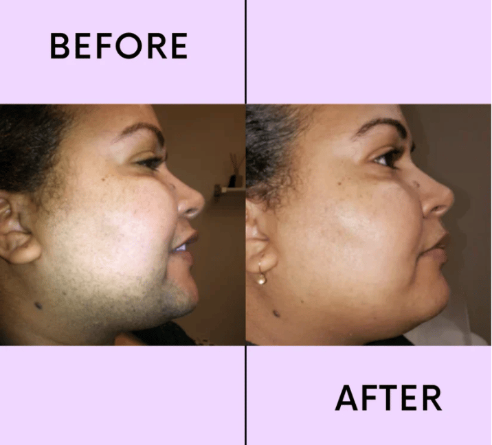 💖LAST DAY 49% OFF-🔥Hair Removal Kit