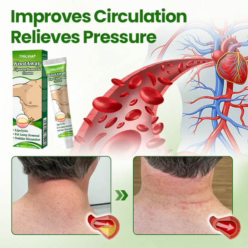 ⏰Last Day Promotion: 60% OFF🔥 TRILVIA® KnotAway Lipoma Removal Cream
