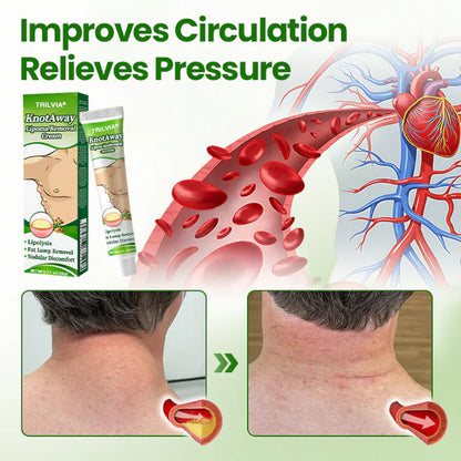 ⏰Last Day Promotion: 60% OFF🔥 TRILVIA® KnotAway Lipoma Removal Cream