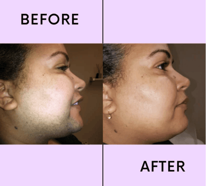 💖LAST DAY 49% OFF-🔥Hair Removal Kit