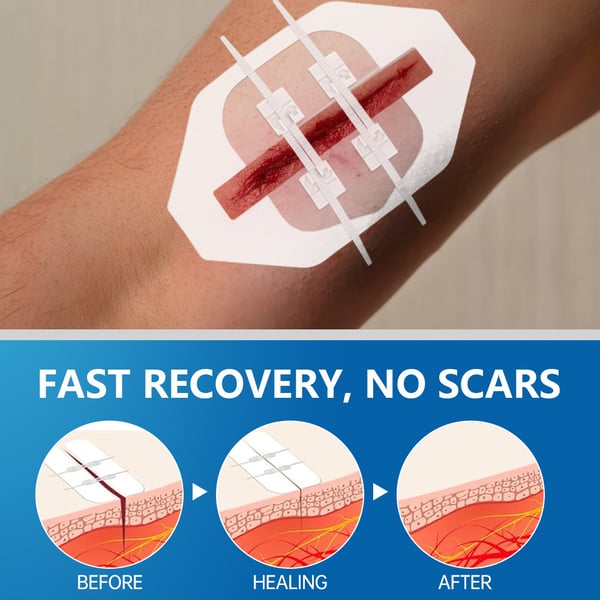 🔥Limited-Time Deal 49% OFF - Emergency Butterfly Bandaids for Wound Closure