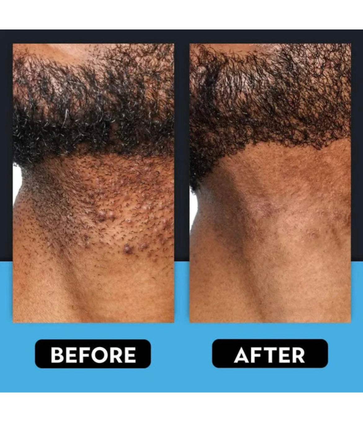 Smoothing Solution Ingrown Hair Treatment: Glide Your Way to Silky-Smooth, Bump-Free Skin