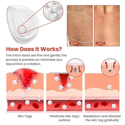 Natravor™ Skin Tag Removal Patch - 144 Patches