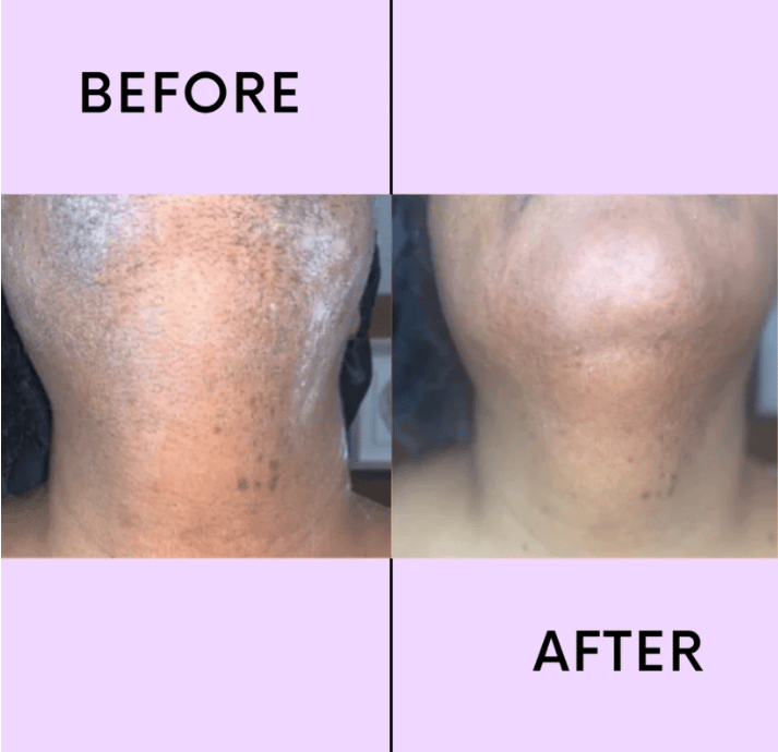 💖LAST DAY 49% OFF-🔥Hair Removal Kit