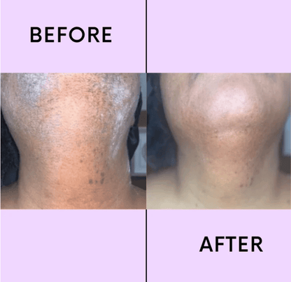 💖LAST DAY 49% OFF-🔥Hair Removal Kit